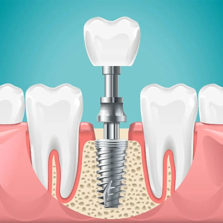 How Dental Implants Minimise Sinus Complications and Protect Upper Jaw Health